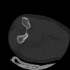 SPORK, NICO - 22.03.1976 - 02.08.2022 - CT obere Extremität - 17:51:17